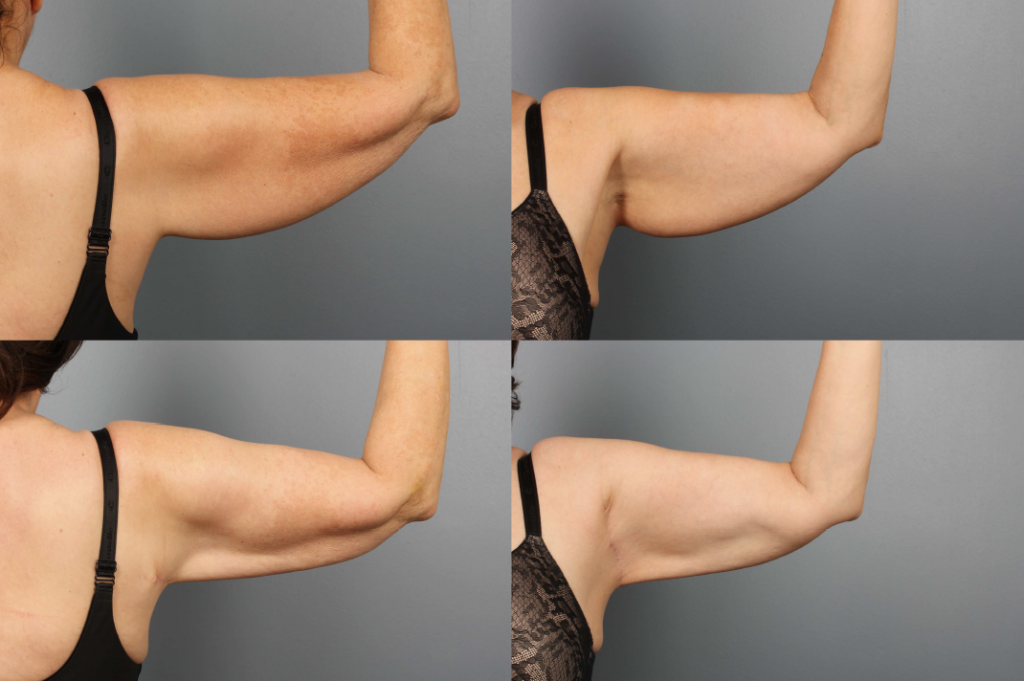 brachioplasty