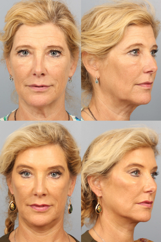 лифтинг маска. Cheek lift (чек-лифтинг) спб. средняя треть лица. эффект от круговой подтяжки лица. Cheek lifting.