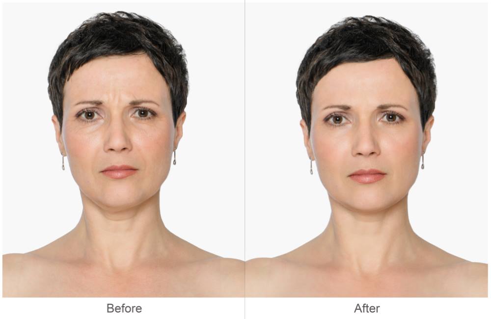 Cheek Lift, Brow Lift & Blepharoplasty Before & After Photos