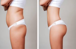 Where Can You Get Liposuction? | Top Lipo Areas