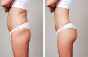 Liposuction Austin